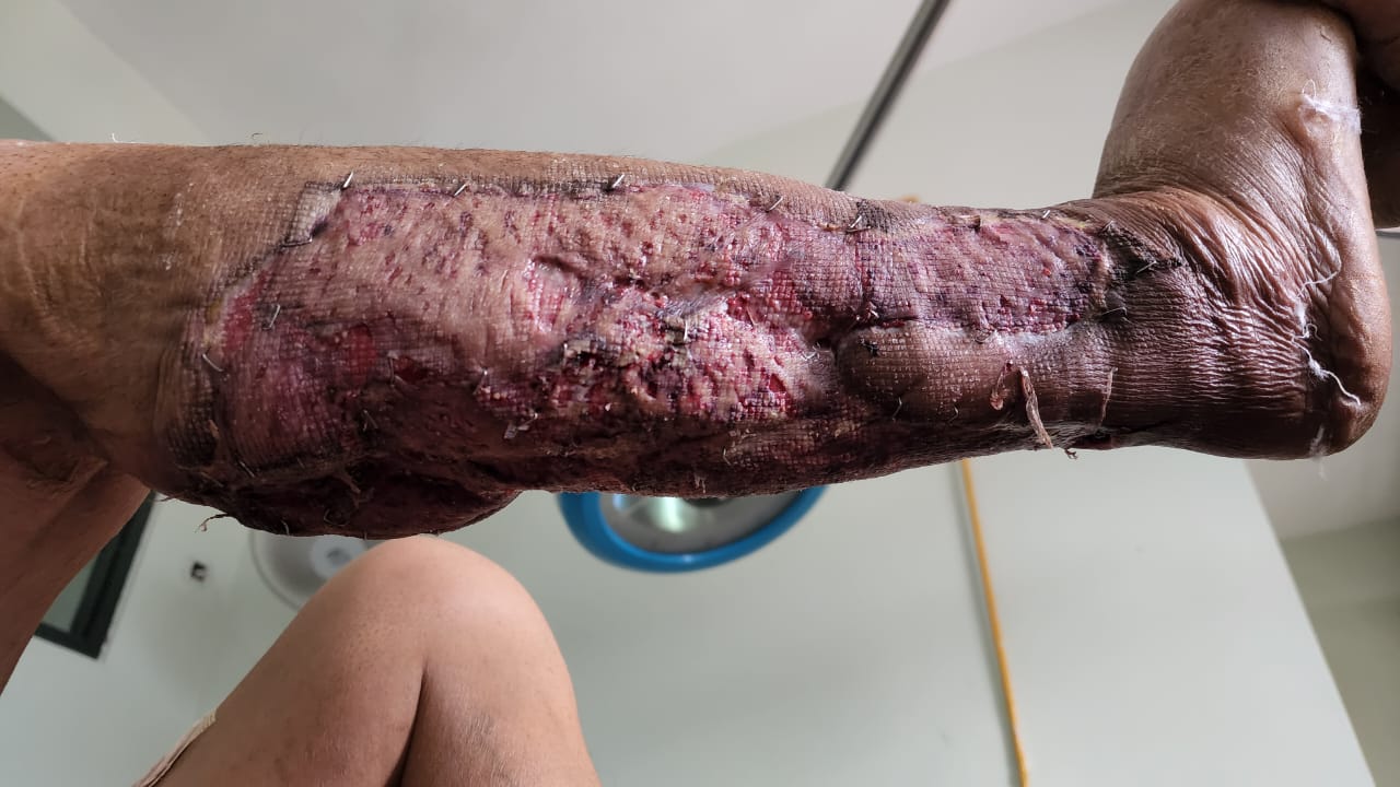 split skin grafting in Mandi HP